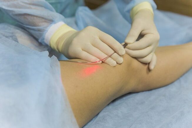 Barizeen laser tratamendua