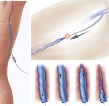 barizeak tratatzeko metodoa - endovenous laser koagulazioa