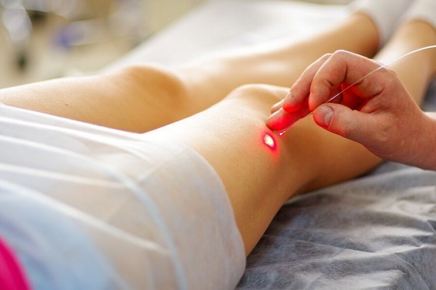 barizeetarako laser tratamendua